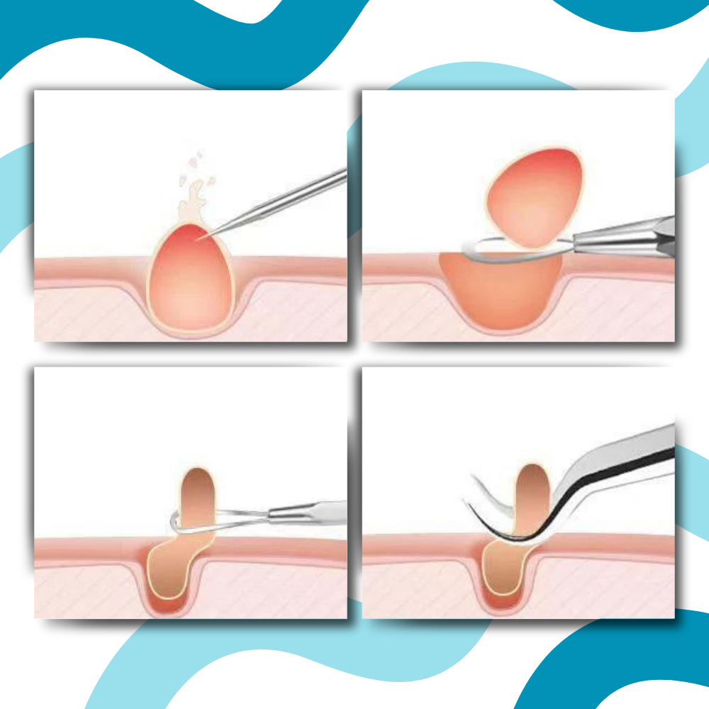 Pinzas faciales de alta precisión - Ozerty