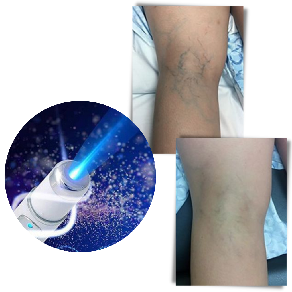 Bolígrafo de terapia cutánea con luz azul - Ozerty