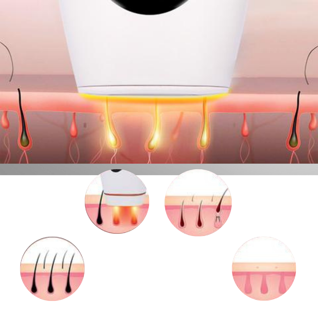 Aparato de depilación láser IPL - Ozerty