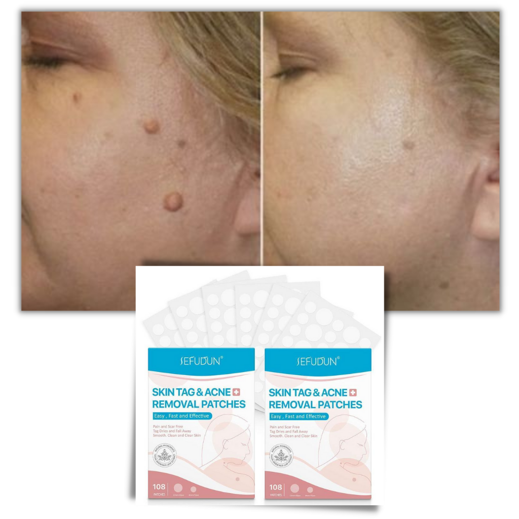 Parche de tratamiento para la eliminación de los lunares - Ozerty