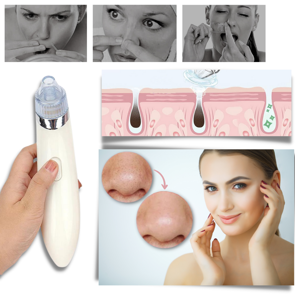Set de eliminador facial de puntos negros - Ozerty