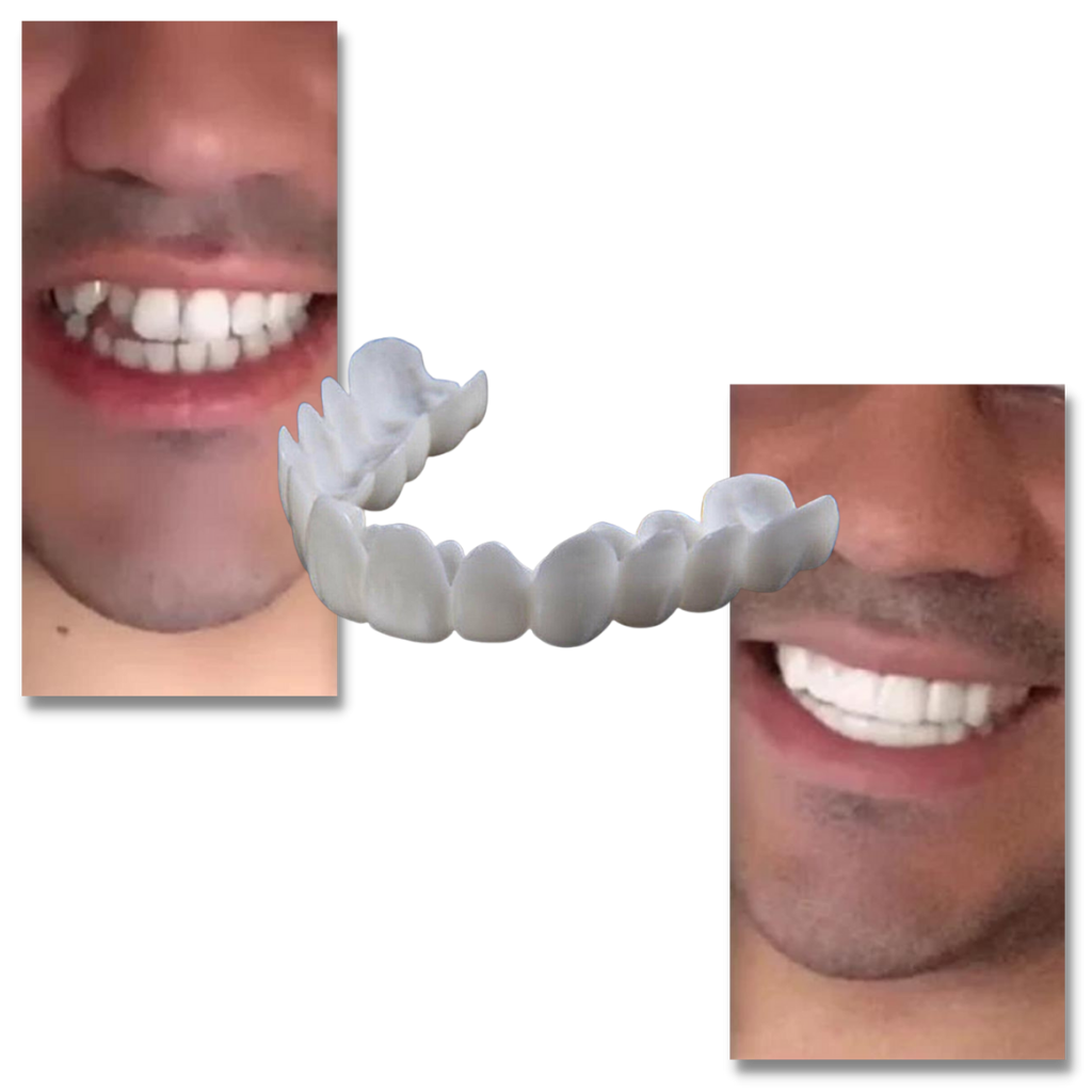 Cobertura dental de la sonrisa perfecta: carillas cómodas - Ozerty